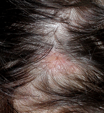 lichen planus scalp