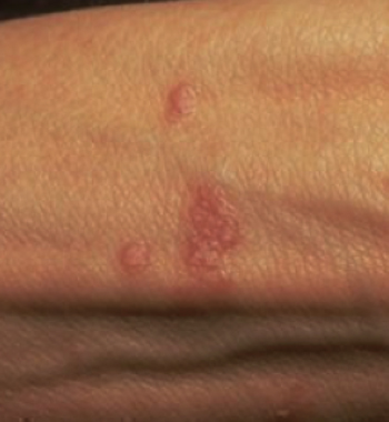 Lichen Planopilaris Symptoms Treatment - RemoteDerm