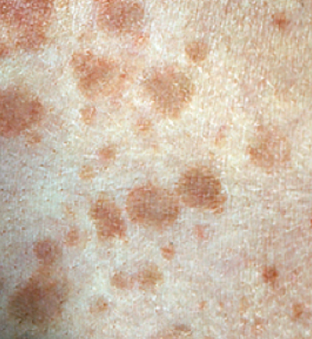 Everything You Need to Know About Tinea Versicolor & Tinea